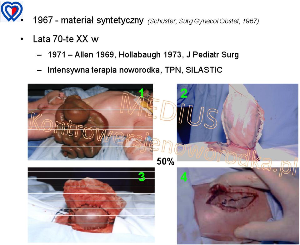 Allen 1969, Hollabaugh 1973, J Pediatr Surg