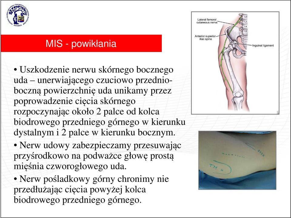 kierunku dystalnym i 2 palce w kierunku bocznym.