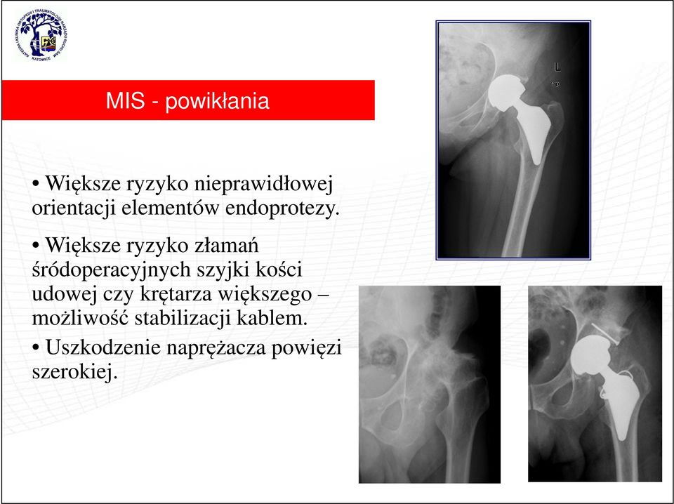 Większe ryzyko złamań śródoperacyjnych szyjki kości udowej