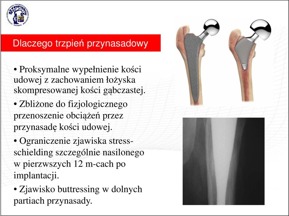 Zbliżone do fizjologicznego przenoszenie obciążeń przez przynasadę kości udowej.