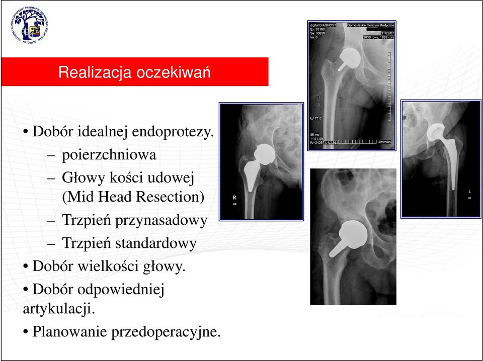 Trzpień przynasadowy Trzpień standardowy Dobór wielkości