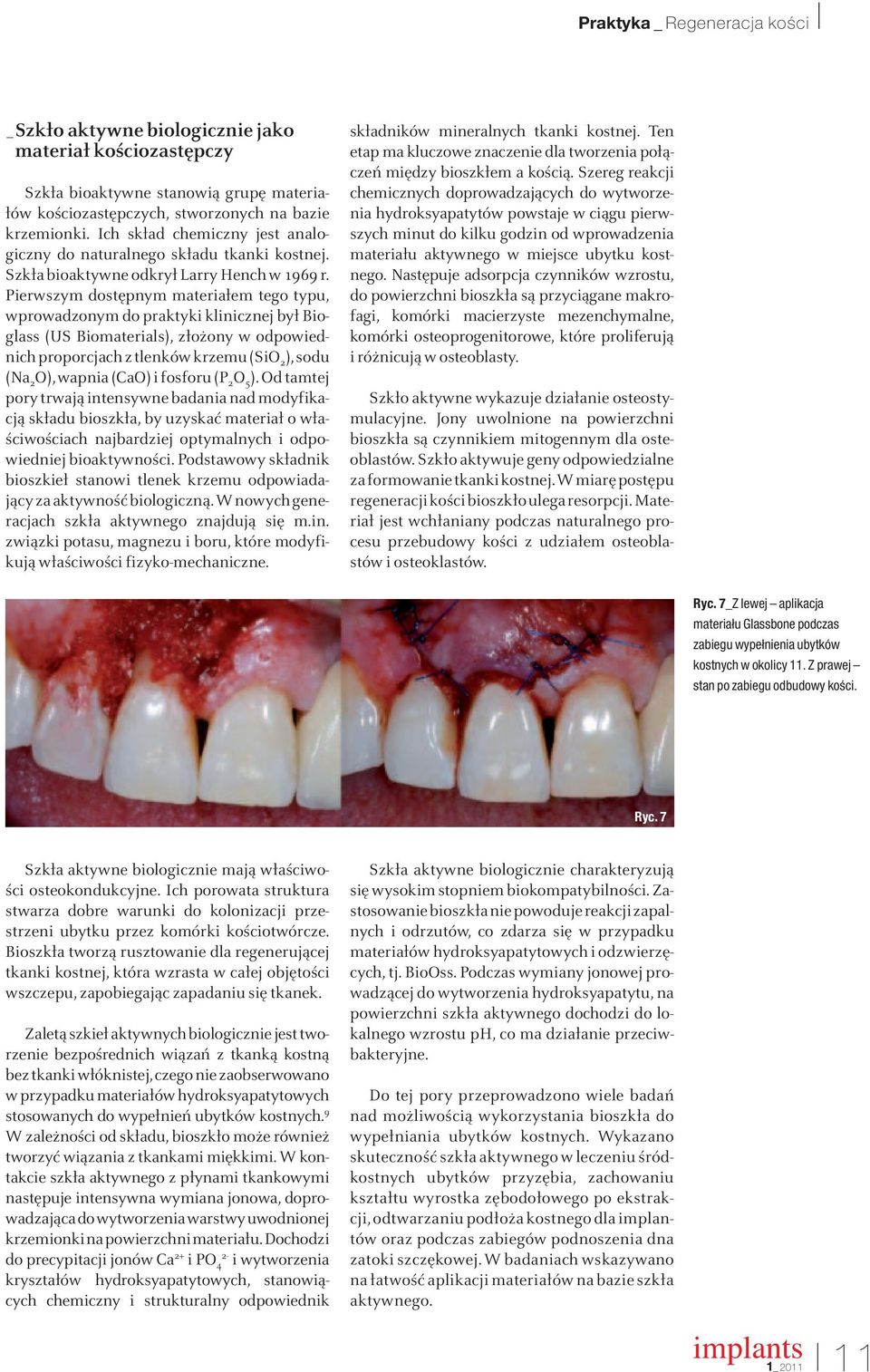 Pierwszym dostępnym materiałem tego typu, wprowadzonym do praktyki klinicznej był Bioglass (US Biomaterials), złożony w odpowiednich proporcjach z tlenków krzemu (SiO 2 ), sodu (Na 2 O), wapnia (CaO)