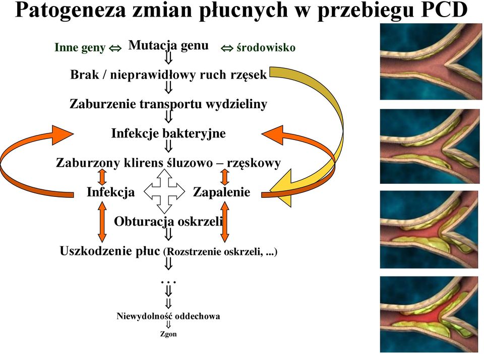 bakteryjne Zaburzony klirens śluzowo rzęskowy Infekcja Zapalenie Obturacja