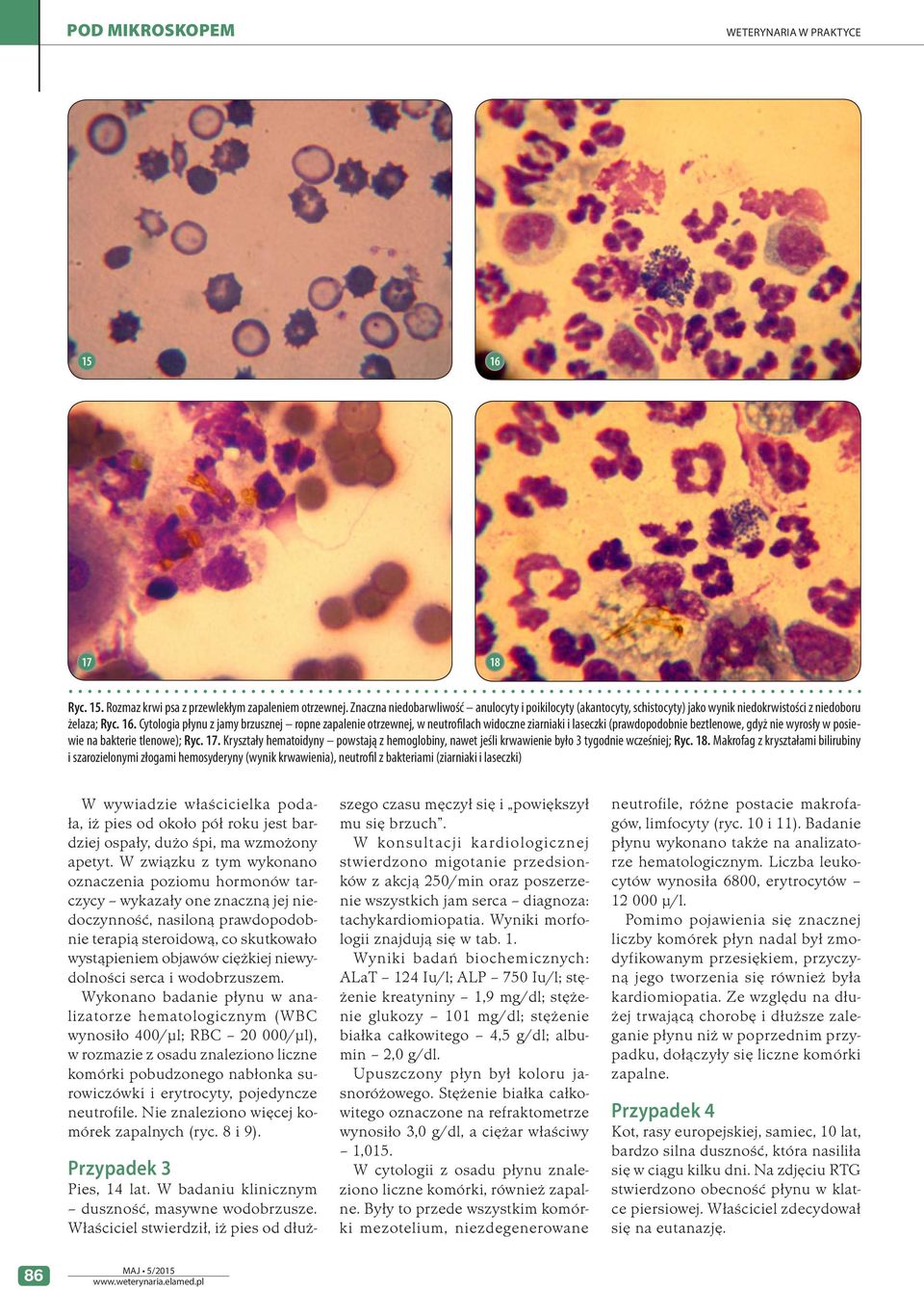 Kryształy hematoidyny powstają z hemoglobiny, nawet jeśli krwawienie było 3 tygodnie wcześniej; Ryc. 18.