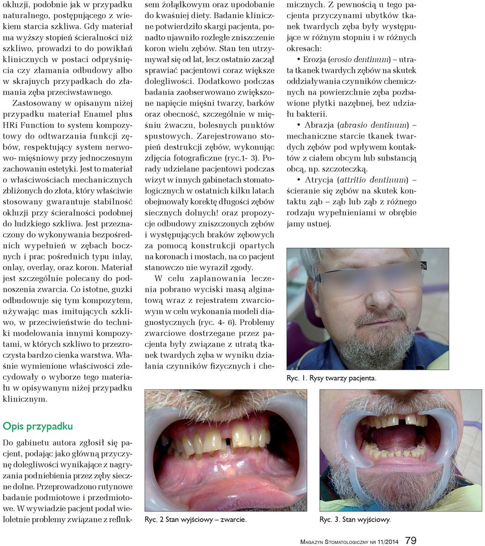 Zastosowany w opisanym niżej przypadku materiał Enamel plus HRi Function to system kompozytowy do odtwarzania funkcji zębów, respektujący system nerwowo mięśniowy przy jednoczesnym zachowaniu