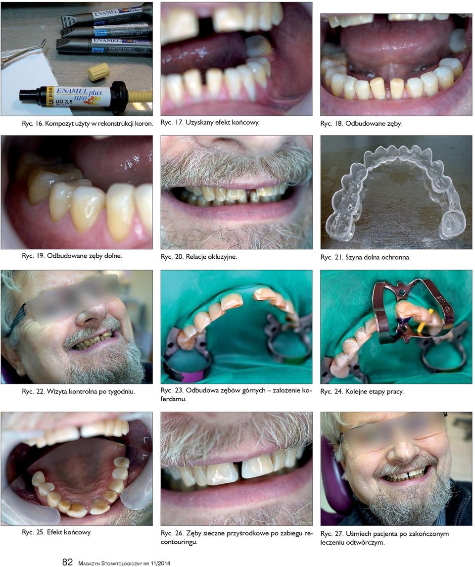 Odbudowa zębów górnych założenie koferdamu. Ryc. 24. Kolejne etapy pracy. Ryc. 25. Efekt końcowy. Ryc. 26.