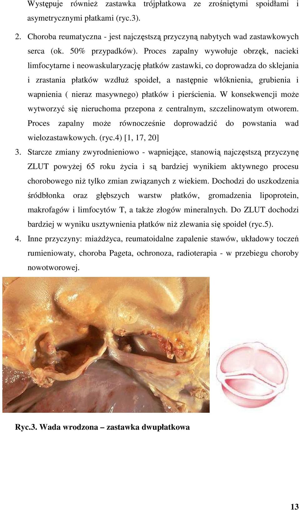 Proces zapalny wywołuje obrzęk, nacieki limfocytarne i neowaskularyzację płatków zastawki, co doprowadza do sklejania i zrastania płatków wzdłuŝ spoideł, a następnie włóknienia, grubienia i wapnienia