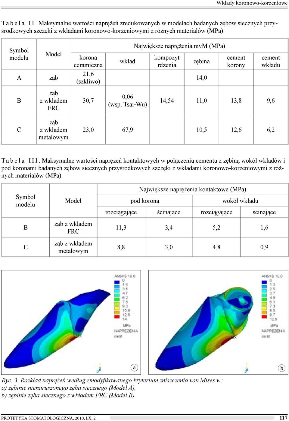 wkład Największe naprężenia mvm (MPa) kompozyt rdzenia zębina cement korony cement wkładu A ząb 21,6 (szkliwo) 14,0 B ząb z wkładem FRC 30,7 0,06 (wsp.