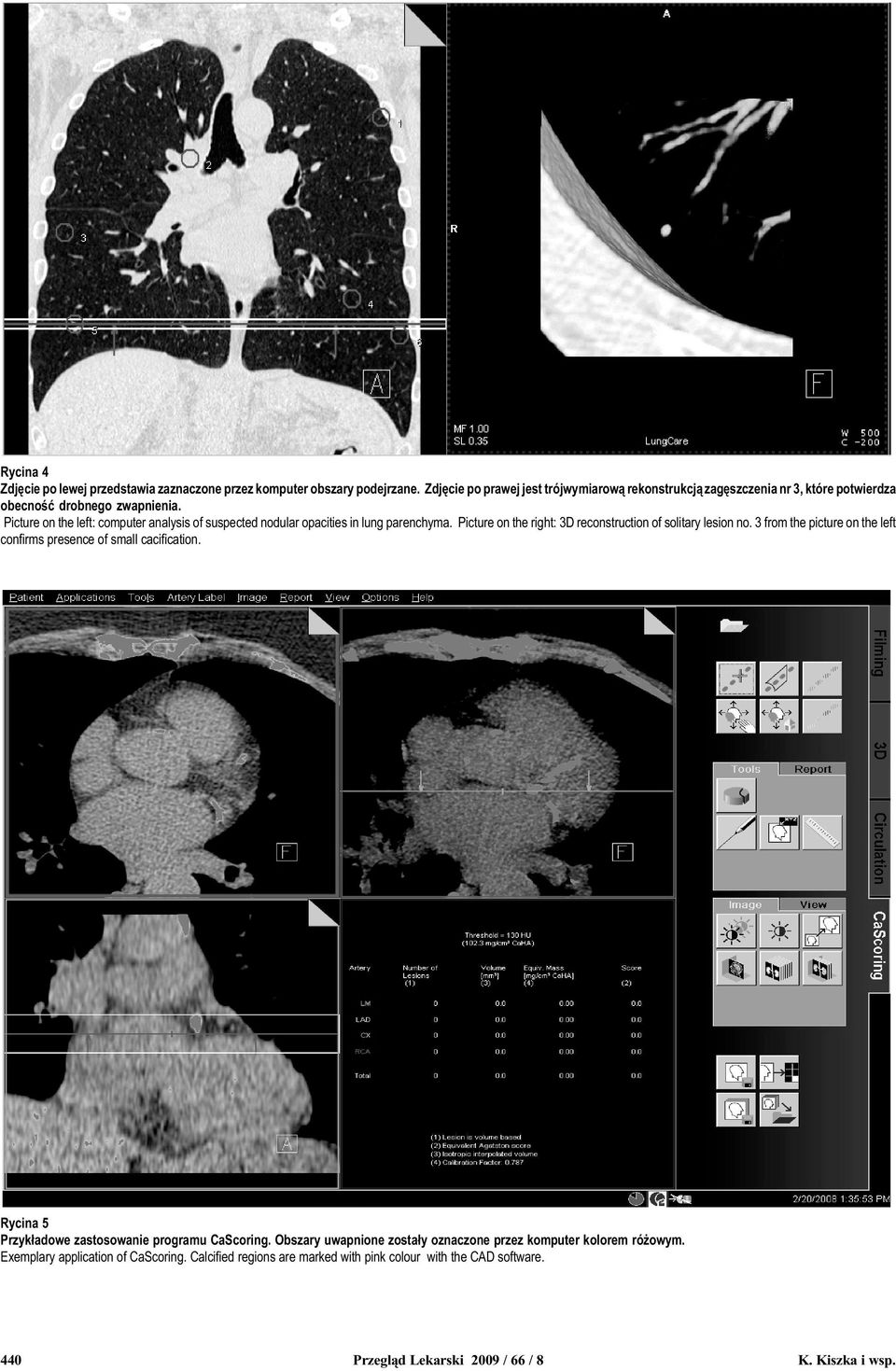 Picture on the left: computer analysis of suspected nodular opacities in lung parenchyma. Picture on the right: 3D reconstruction of solitary lesion no.