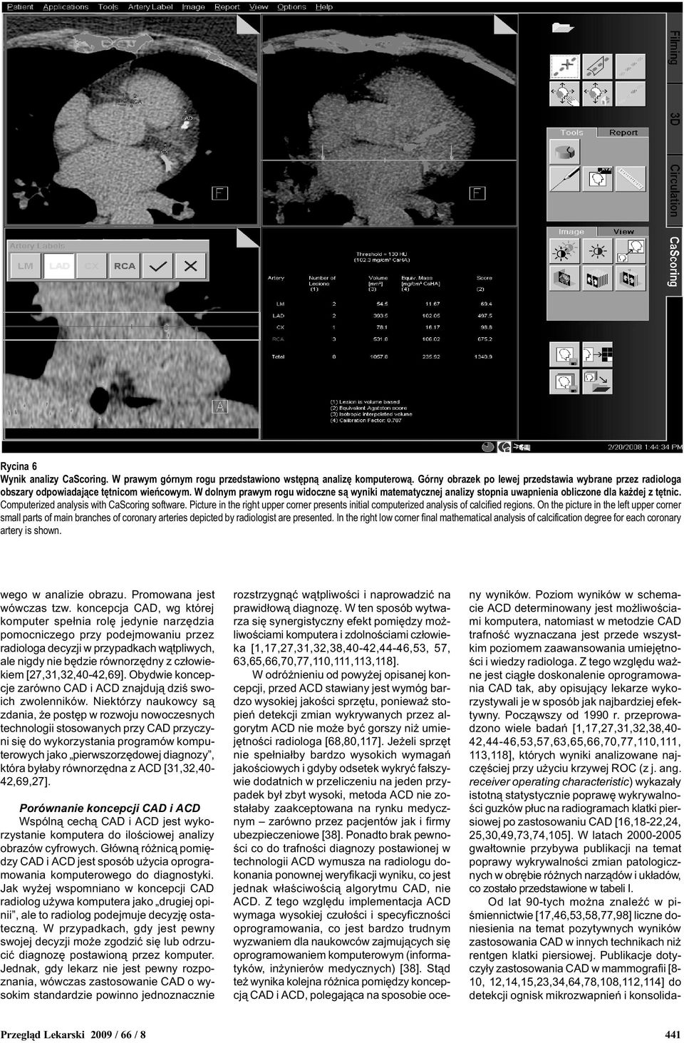 Picture in the right upper corner presents initial computerized analysis of calcified regions.