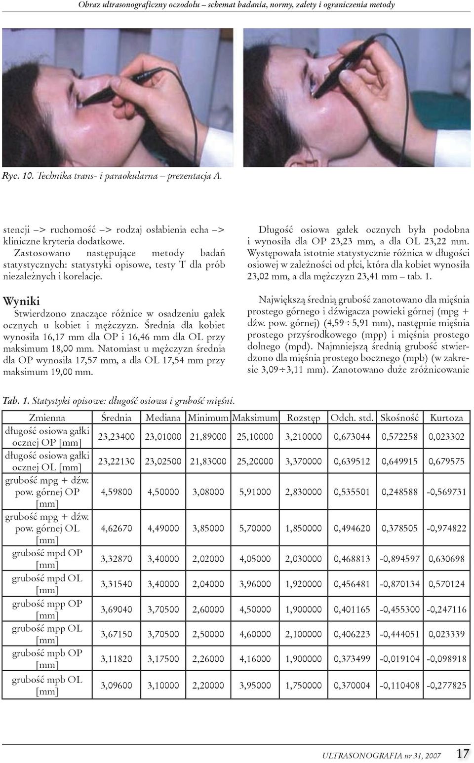 Wyniki stwierdzono znaczące różnice w osadzeniu gałek ocznych u kobiet i mężczyzn. Średnia dla kobiet wynosiła 16,17 mm dla op i 16,46 mm dla ol przy maksimum 18,00 mm.