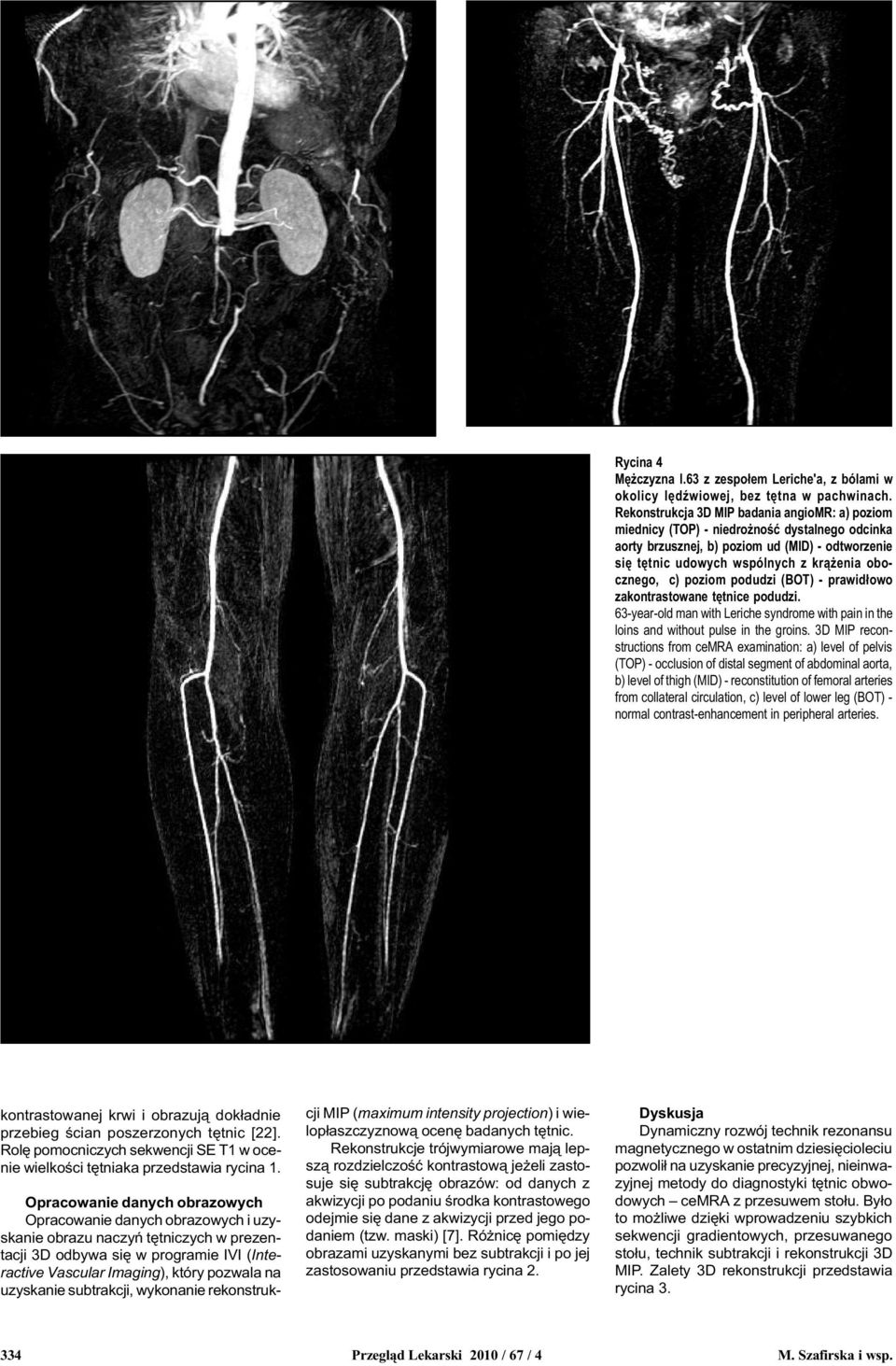 poziom podudzi (BOT) - prawid³owo zakontrastowane têtnice podudzi. 63-year-old man with Leriche syndrome with pain in the loins and without pulse in the groins.