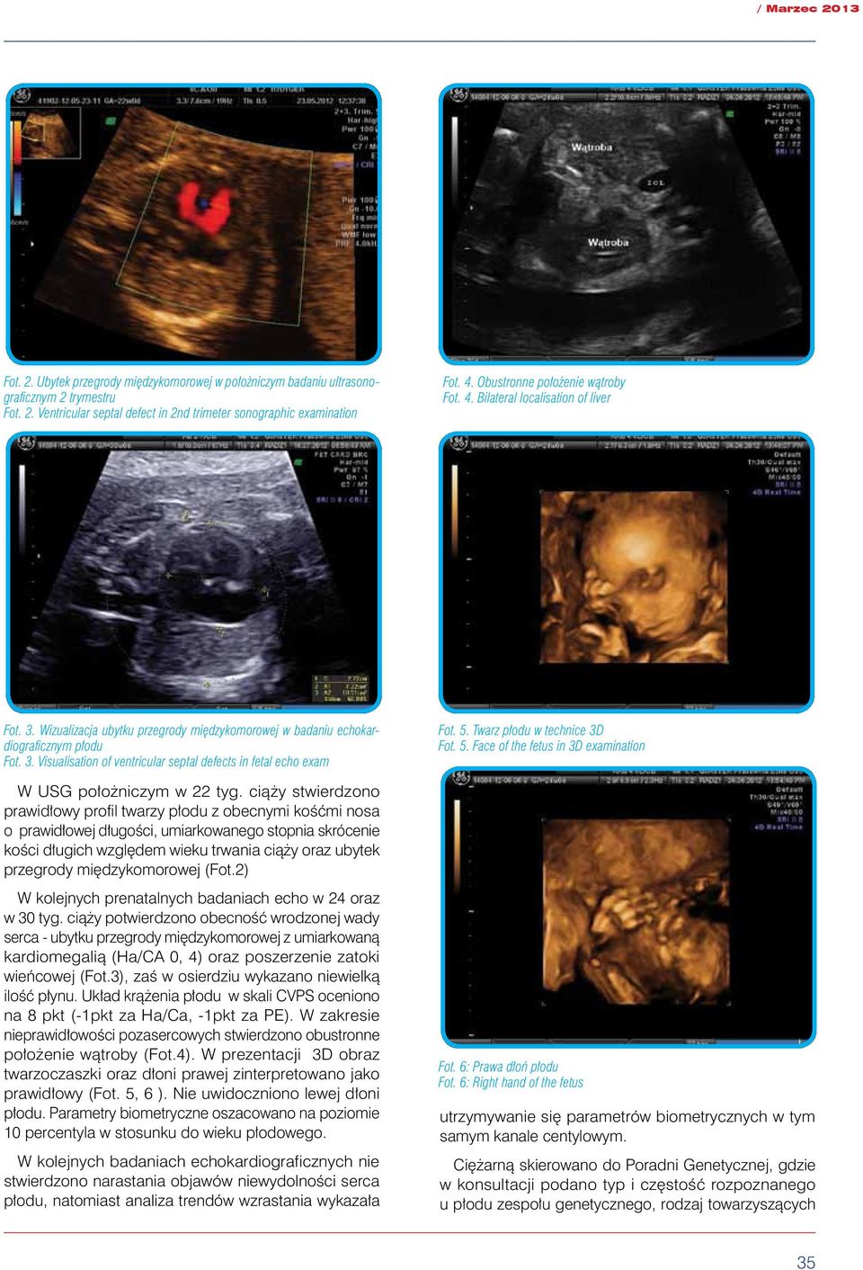 5. Twarz płodu w technice 3D Fot. 5. Face of the fetus in 3D examination W usg położniczym w 22 tyg.