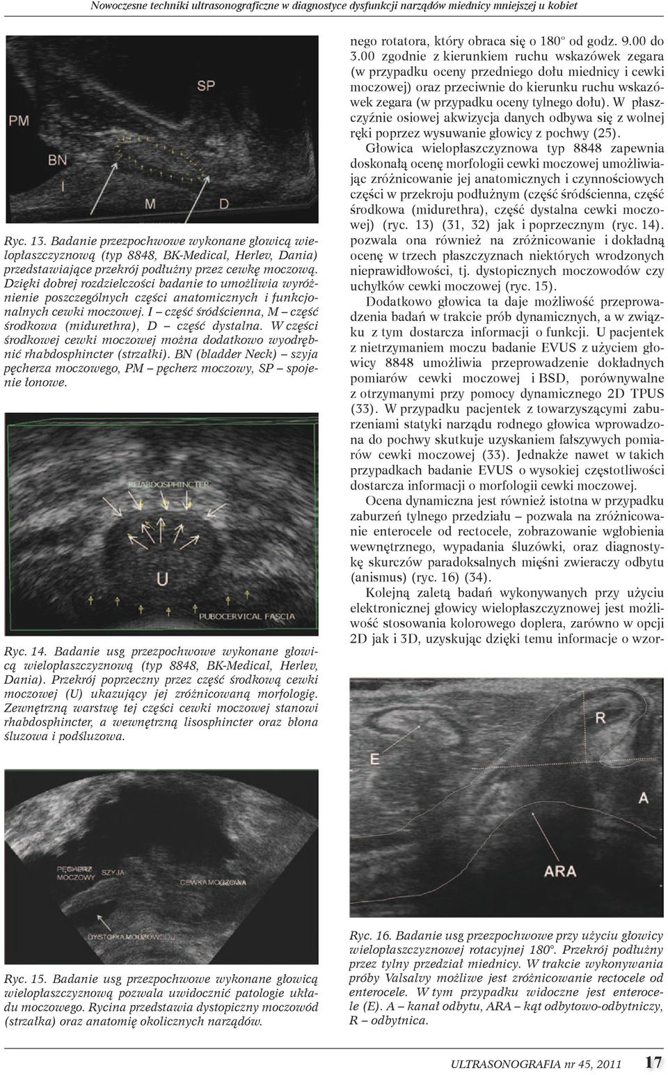 Dzięki dobrej rozdzielczości badanie to umożliwia wyróżnienie poszczególnych części anatomicznych i funkcjonalnych cewki moczowej. I część śródścienna, M część środkowa (midurethra), D część dystalna.