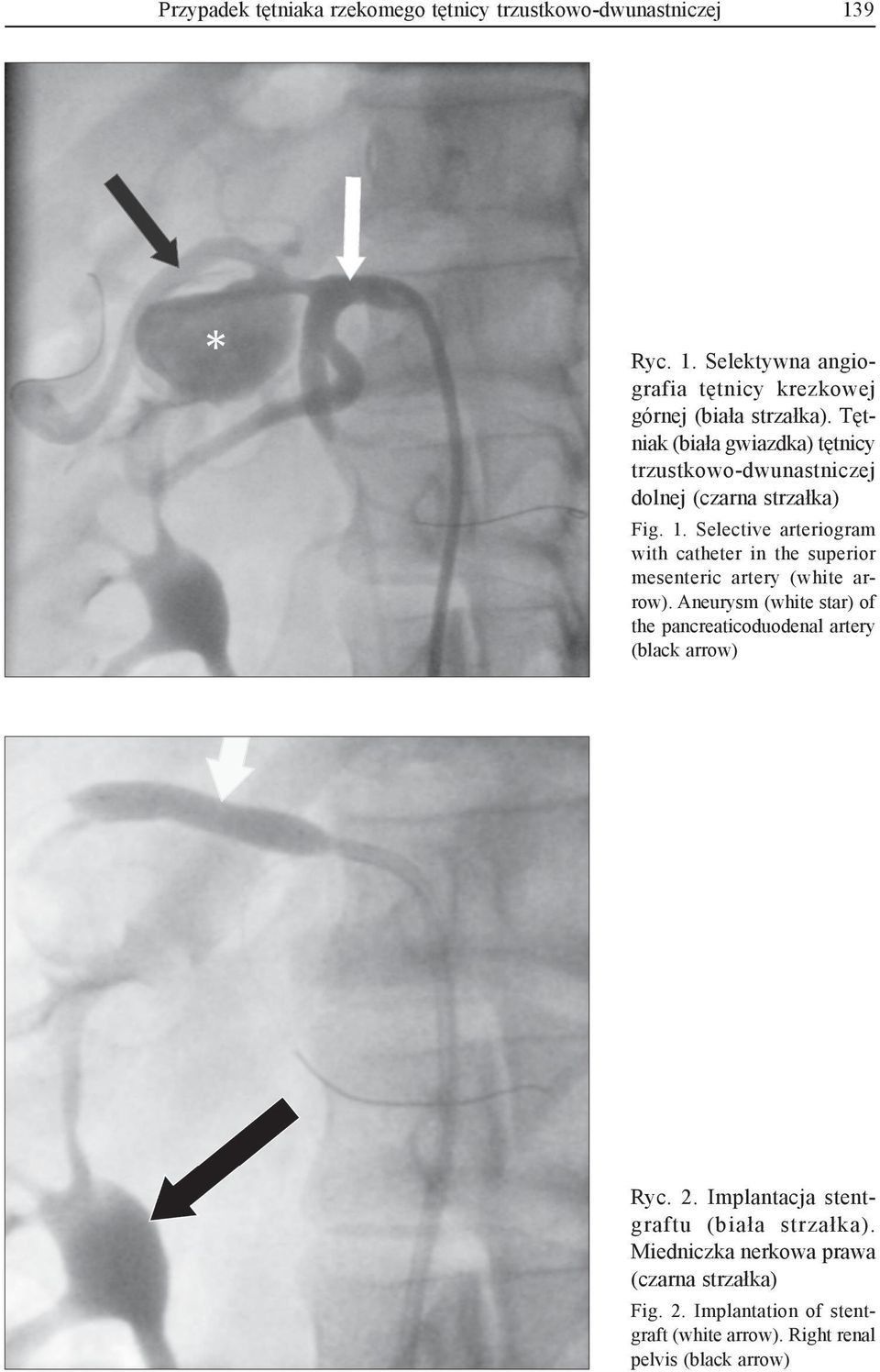 Selective arteriogram with catheter in the superior mesenteric artery (white arrow).