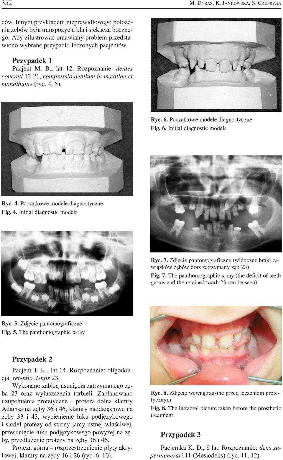 Rozpoznanie: dentes concreti 12 21, compressio dentium in maxillae et mandibulae (ryc. 4, 5). Ryc. 6. Początkowe modele diagnostyczne Fig. 6. Initial diagnostic models Ryc. 4. Początkowe modele diagnostyczne Fig. 4. Initial diagnostic models Ryc. 7.