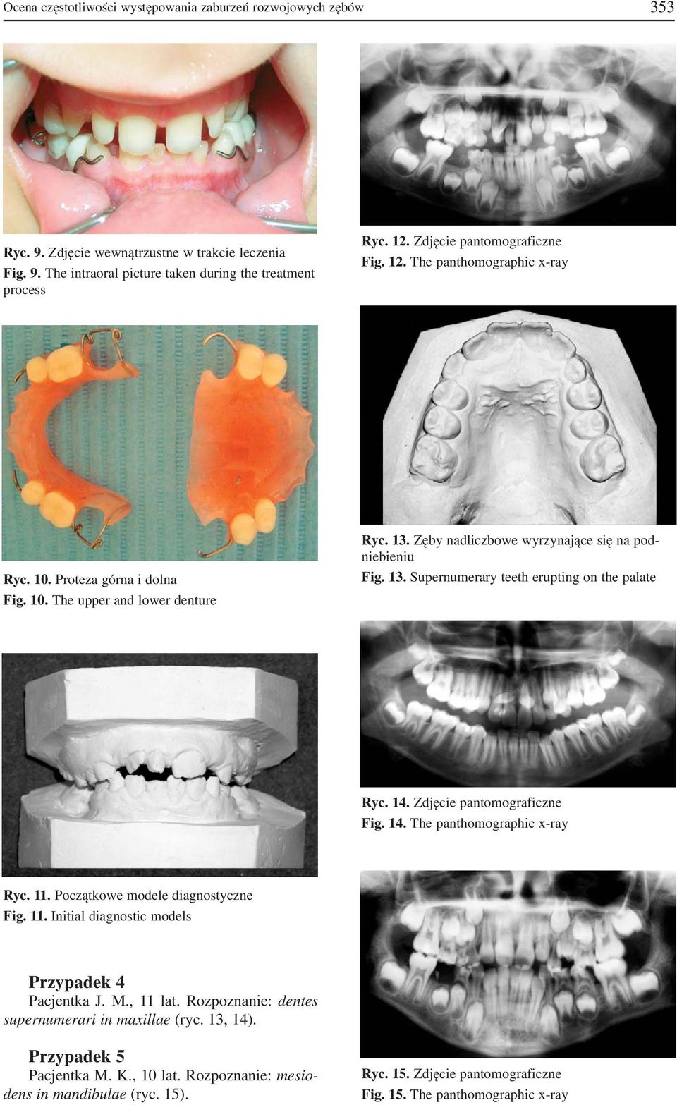 14. Zdjęcie pantomograficzne Fig. 14. The panthomographic x ray Ryc. 11. Początkowe modele diagnostyczne Fig. 11. Initial diagnostic models Przypadek 4 Pacjentka J. M., 11 lat.