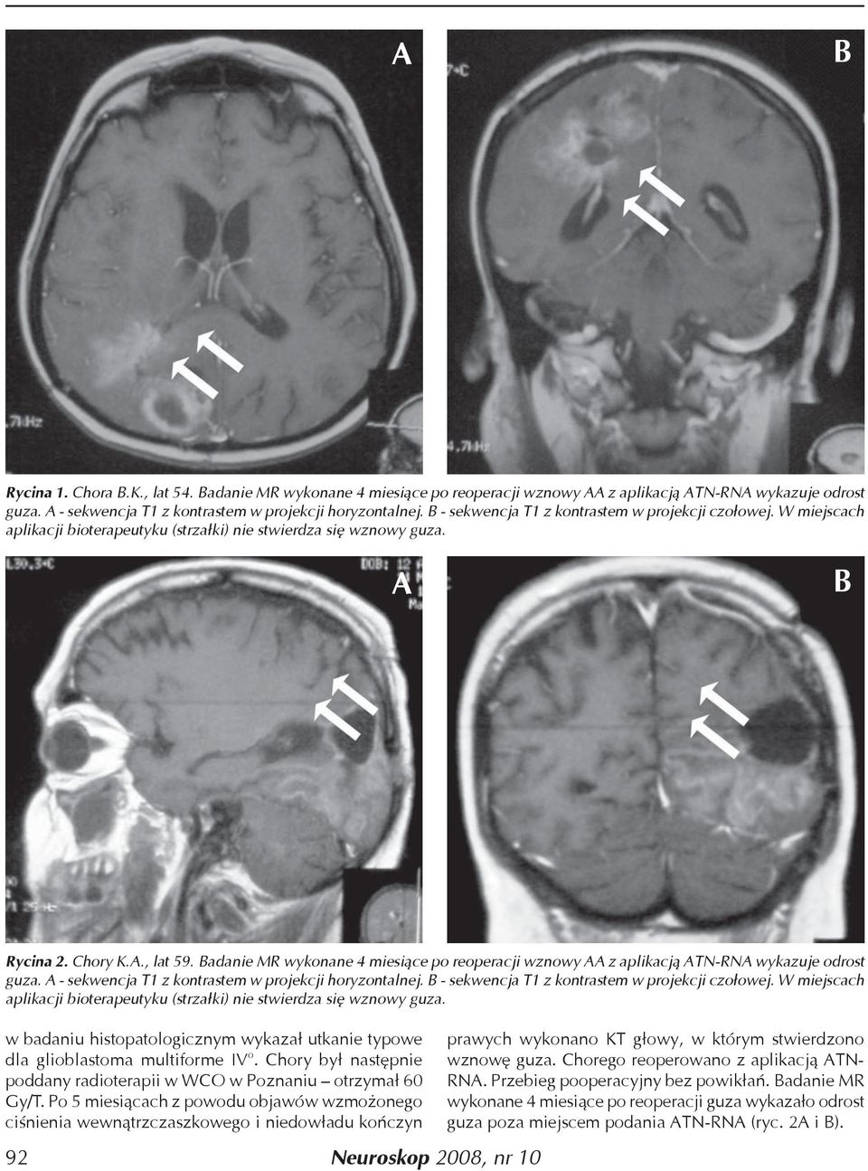 Badanie MR wykonane 4 miesiące po reoperacji wznowy AA z aplikacją ATN-RNA wykazuje odrost guza. A - sekwencja T1 z kontrastem w projekcji horyzontalnej.
