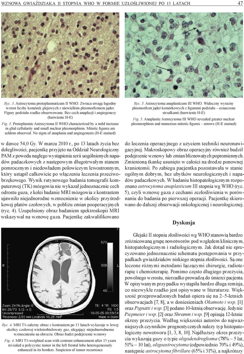 Protoplasmic Astrocytoma II WHO characterized by a mild increase in glial cellularity and small nuclear pleomorphism. Mitotic figures are seldom observed.