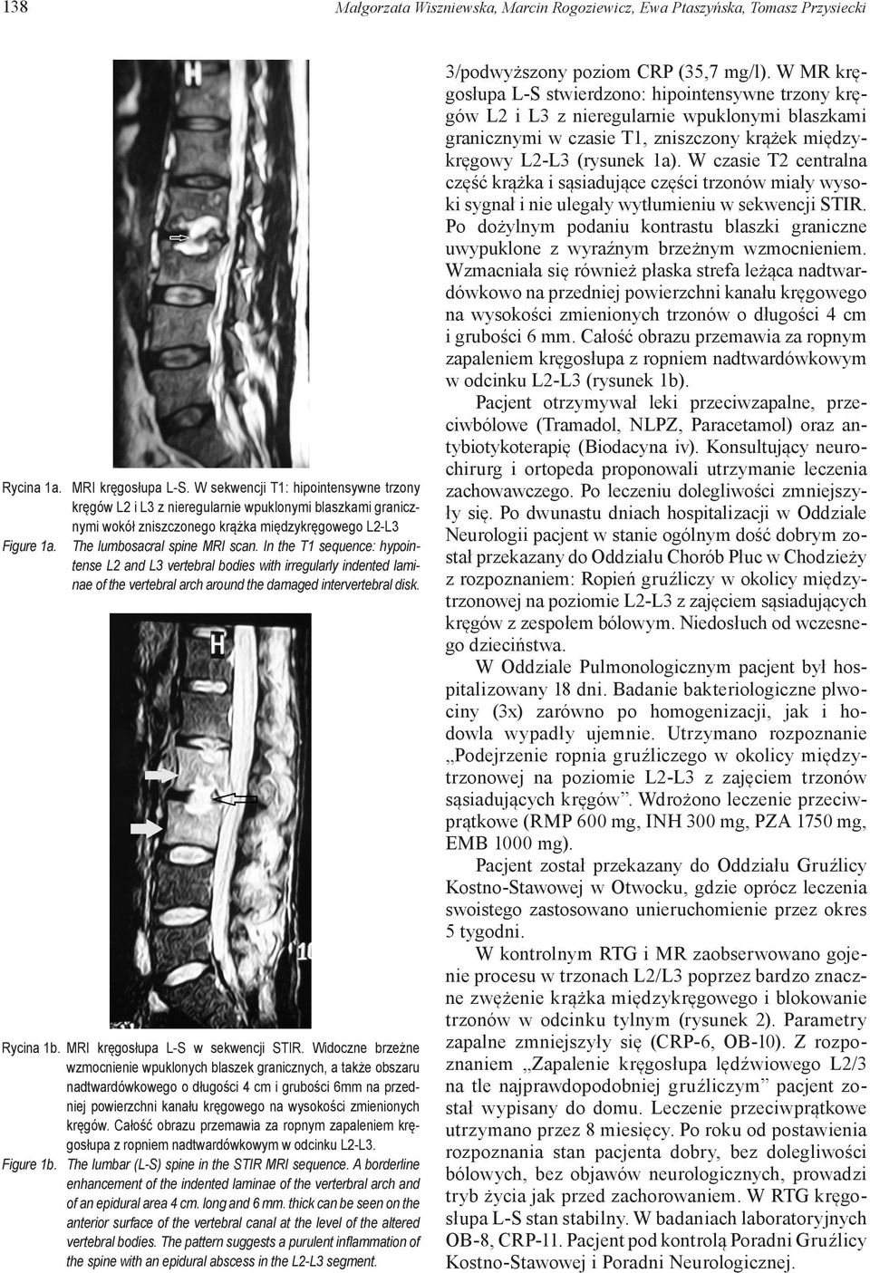 In the T1 sequence: hypointense L2 and L3 vertebral bodies with irregularly indented laminae of the vertebral arch around the damaged intervertebral disk. Rycina 1b.