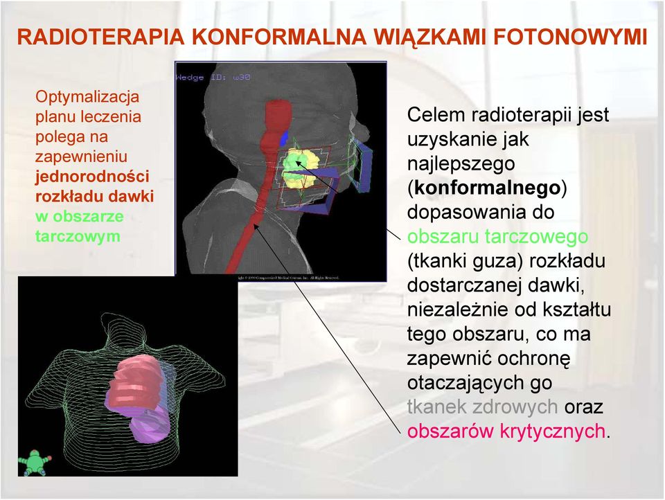 (konformalnego) dopasowania do obszaru tarczowego (tkanki guza) rozkładu dostarczanej dawki,