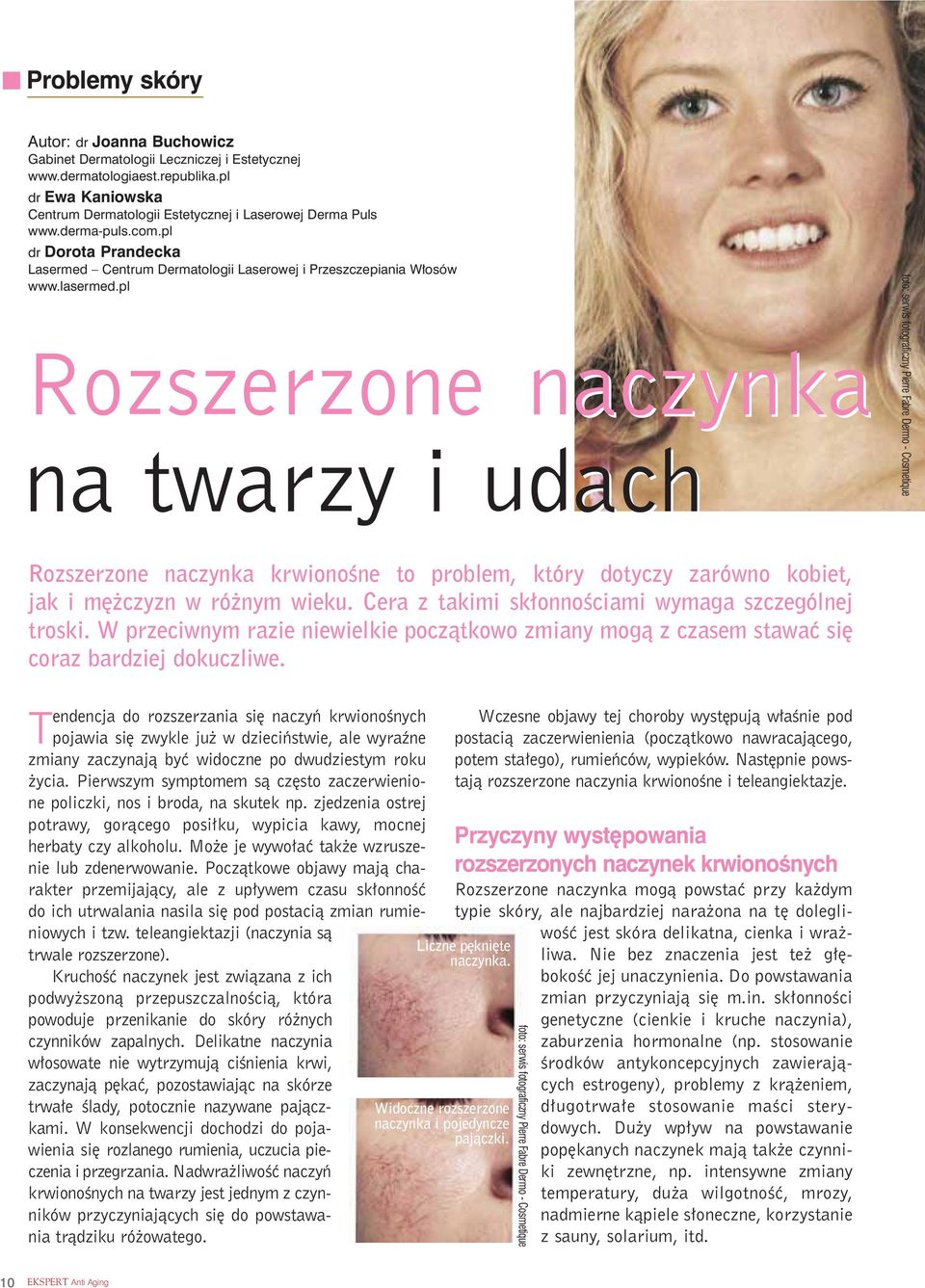 pl Rozszerzone naczynka na twarzy i udach foto: serwis fotograficzny Pierre Fabre Dermo - Cosmetique Rozszerzone naczynka krwionoêne to problem, który dotyczy zarówno kobiet, jak i m czyzn w ró nym