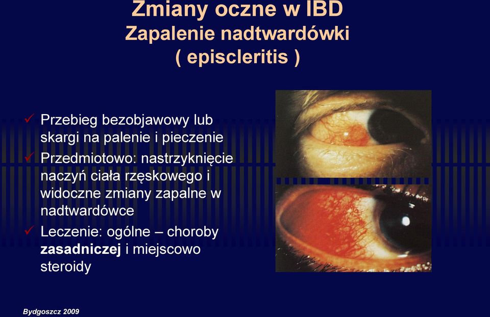 nastrzyknięcie naczyń ciała rzęskowego i widoczne zmiany zapalne w