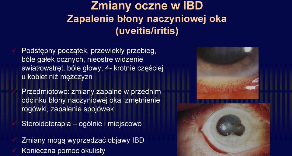 niż mężczyzn Przedmiotowo: zmiany zapalne w przednim odcinku błony naczyniowej oka, zmętnienie rogówki,