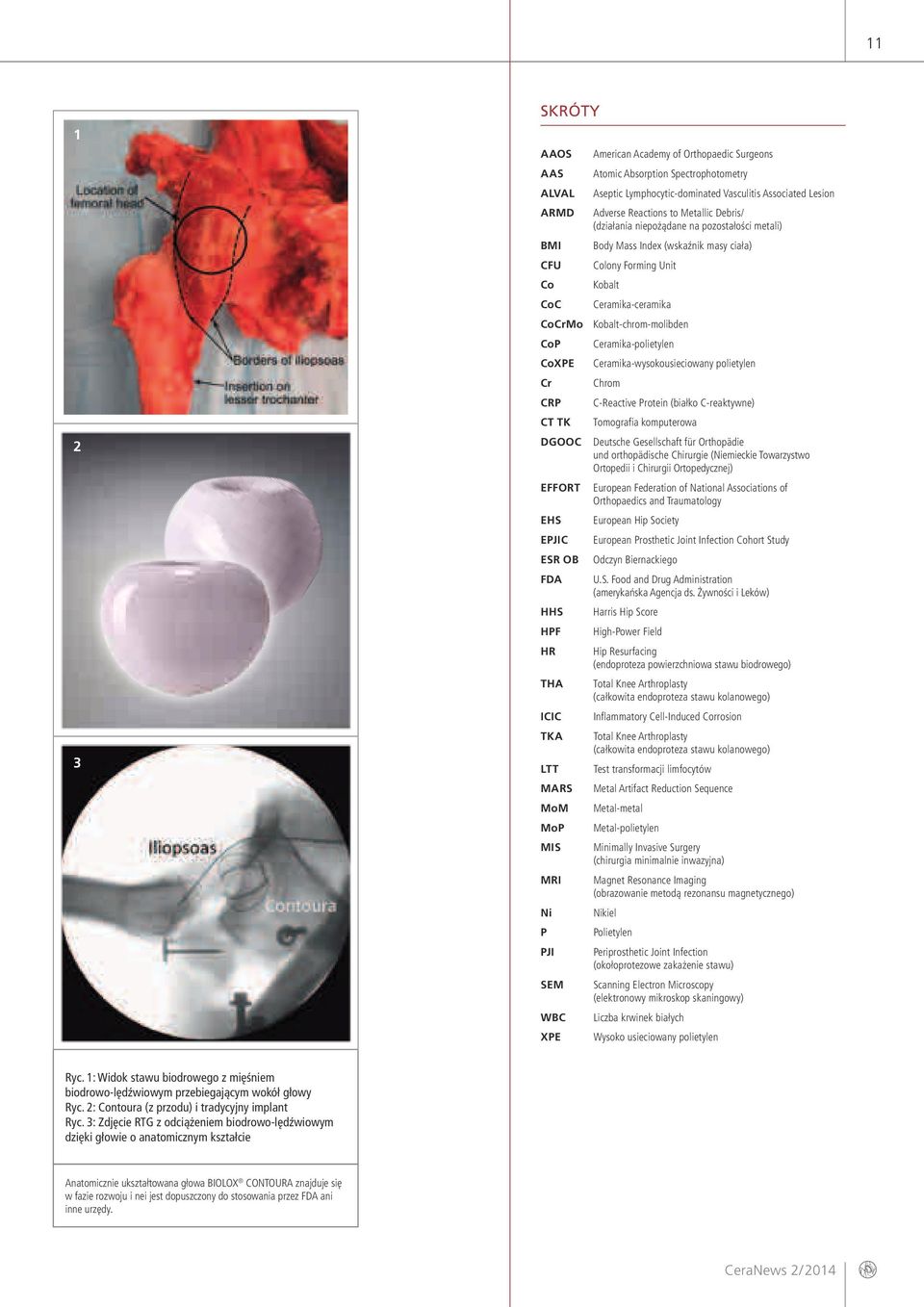 Ceramika-polietylen CoXPE Ceramika-wysokousieciowany polietylen Cr Chrom CRP C-Reactive Protein (białko C-reaktywne) CT TK Tomografia komputerowa DGOOC Deutsche Gesellschaft für Orthopädie und