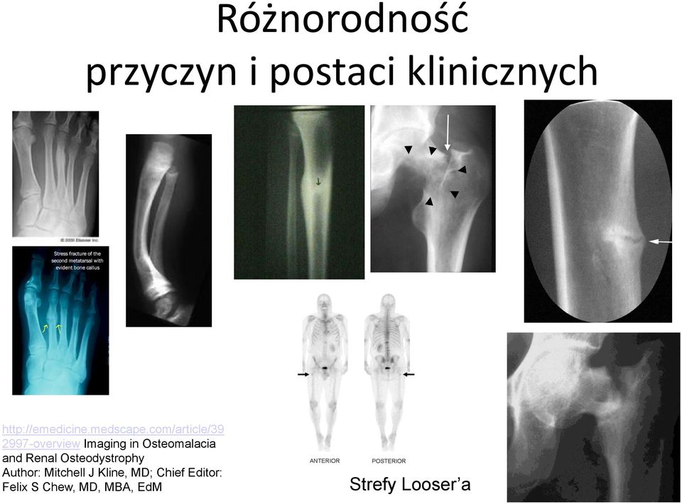 com/article/39 2997-overview Imaging in Osteomalacia and