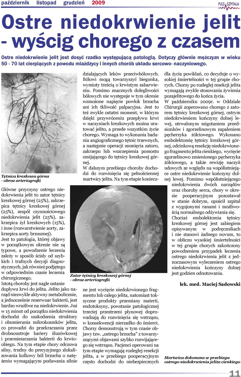 Tętnica krezkowa górna - obraz arteriografii Główne przyczyny ostrego niedokrwienia jelit to zator tętnicy krezkowej górnej (25%), zakrzepica tętnicy krezkowej górnej (25%), zespół czynnościowego