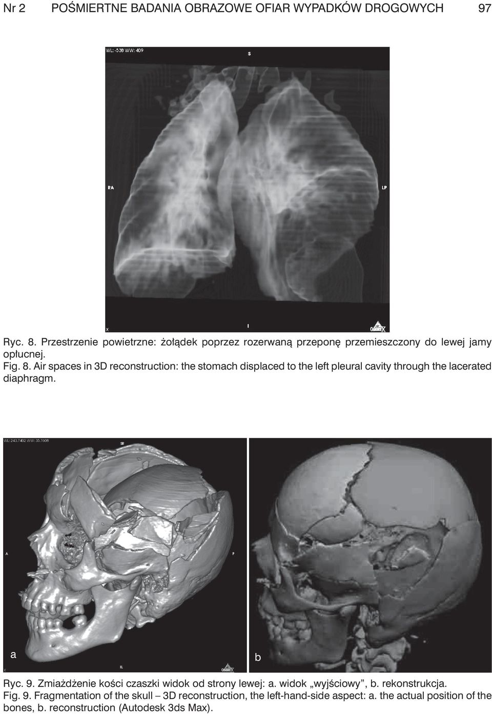 Air spces in 3D reconstruction: the stomch displced to the left pleurl cvity through the lcerted diphrgm. Ryc. 9.