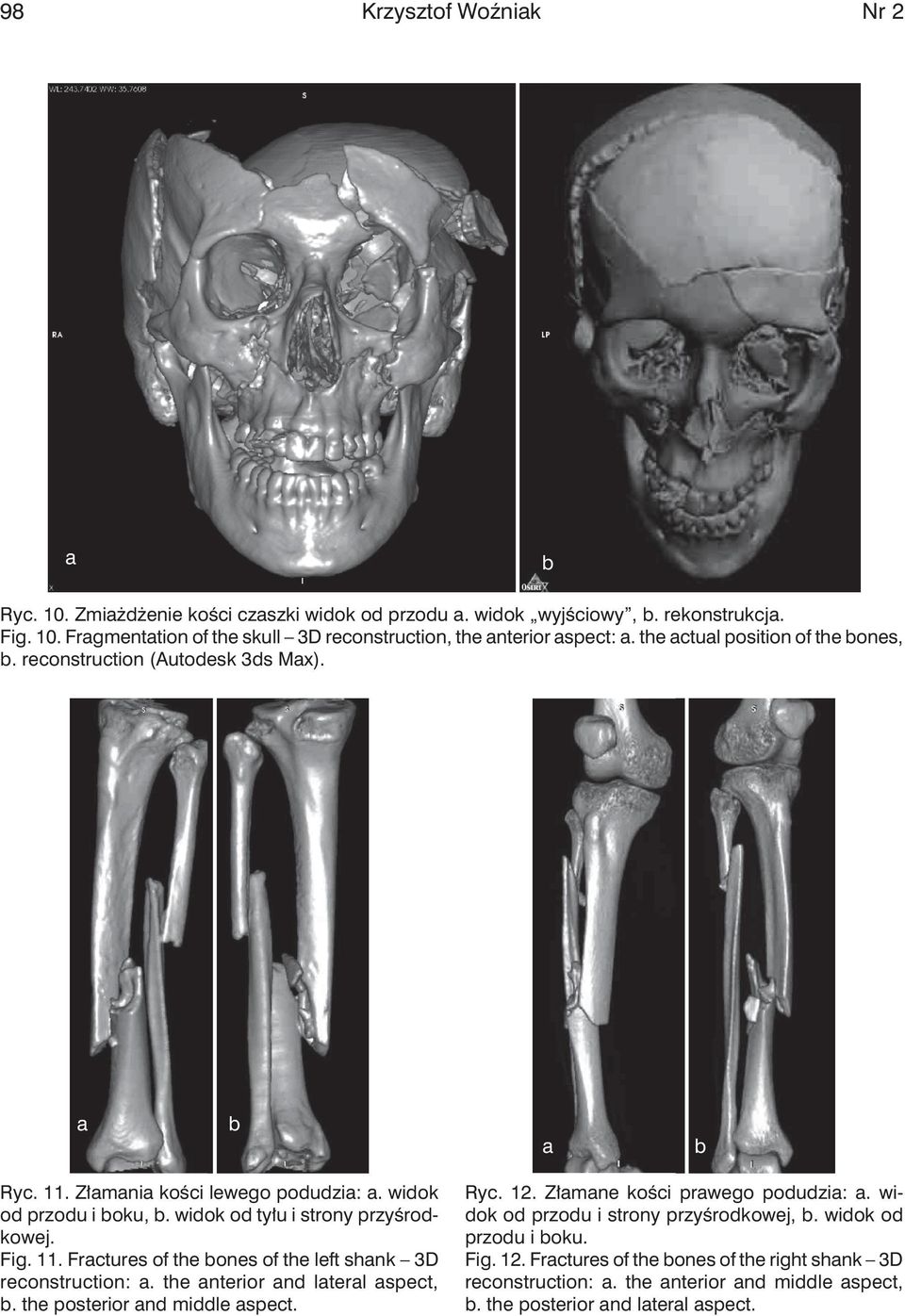 the nterior nd lterl spect,. the posterior nd middle spect. Ryc. 12. Złmne kości prwego podudzi:. widok od przodu i strony przyśrodkowej,. widok od przodu i oku. Fig. 12. Frctures of the ones of the right shnk 3D reconstruction:.