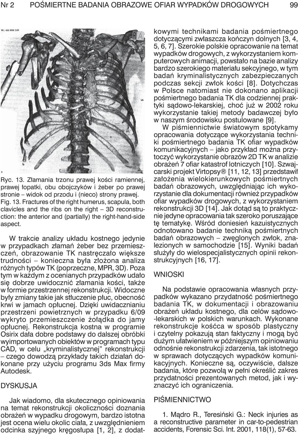 W trkcie nlizy ukłdu kostnego jedynie w przypdkch złmń żeer ez przemieszczeń, orzownie TK nstręczło większe trudności konieczn ył złożon nliz różnych typów TK (poprzeczne, MPR, 3D).