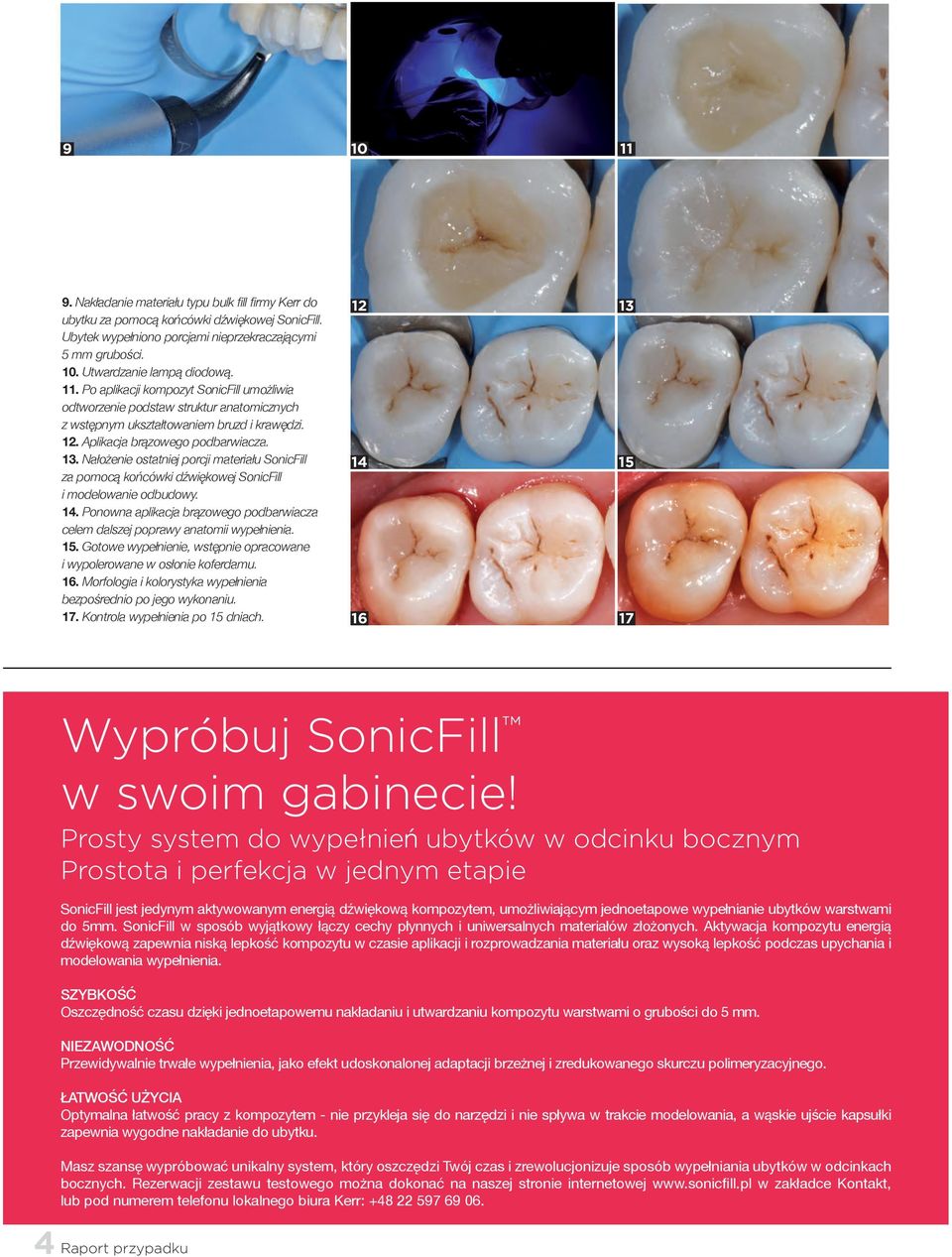 Nałożenie ostatniej porcji materiału SonicFill za pomocą końcówki dźwiękowej SonicFill i modelowanie odbudowy. 14. Ponowna aplikacja brązowego podbarwiacza celem dalszej poprawy anatomii wypełnienia.