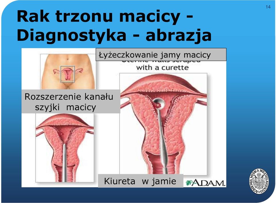 Łyżeczkowanie jamy macicy