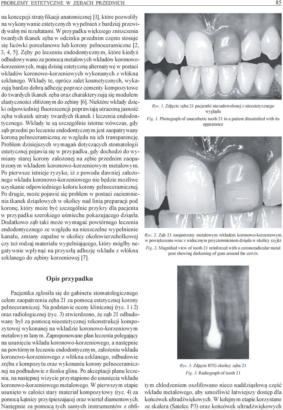 Zęby po leczeniu endodontycznym, które kiedyś odbudowywano za pomocą metalowych wkładów koronowo- -korzeniowych, mają dzisiaj estetyczną alternatywę w postaci wkładów koronowo-korzeniowych wykonanych