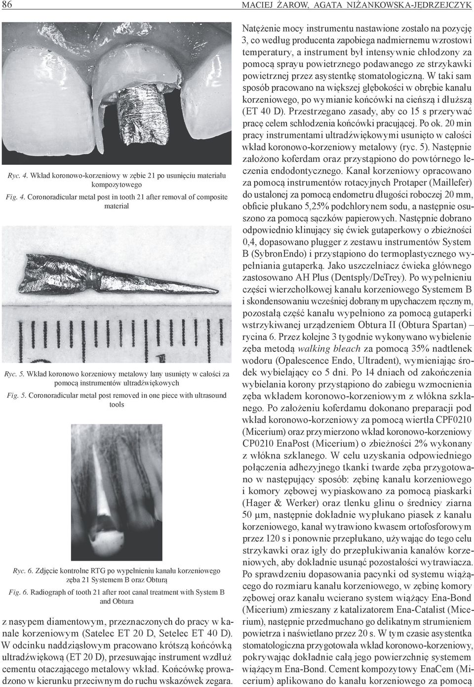 Zdjęcie kontrolne RTG po wypełnieniu kanału korzeniowego zęba 21 Systemem B oraz Obturą Fig. 6.