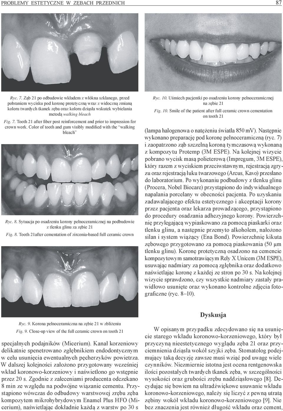 bleach Fig. 7. Tooth 21 after fiber post reinforcement and prior to impression for crown work. Color of tooth and gum visibly modified with the walking bleach Ryc. 8.