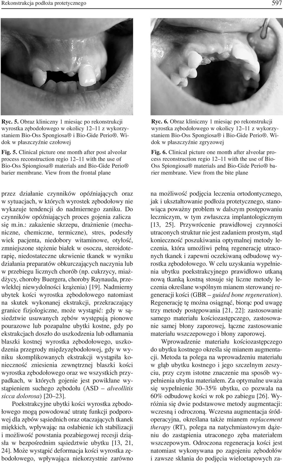 Clinical picture one month after post alveolar process reconstruction regio 12 11 with the use of Bio Oss Spiongiosa materials and Bio Gide Perio barier membrane. View from the frontal plane Ryc. 6.