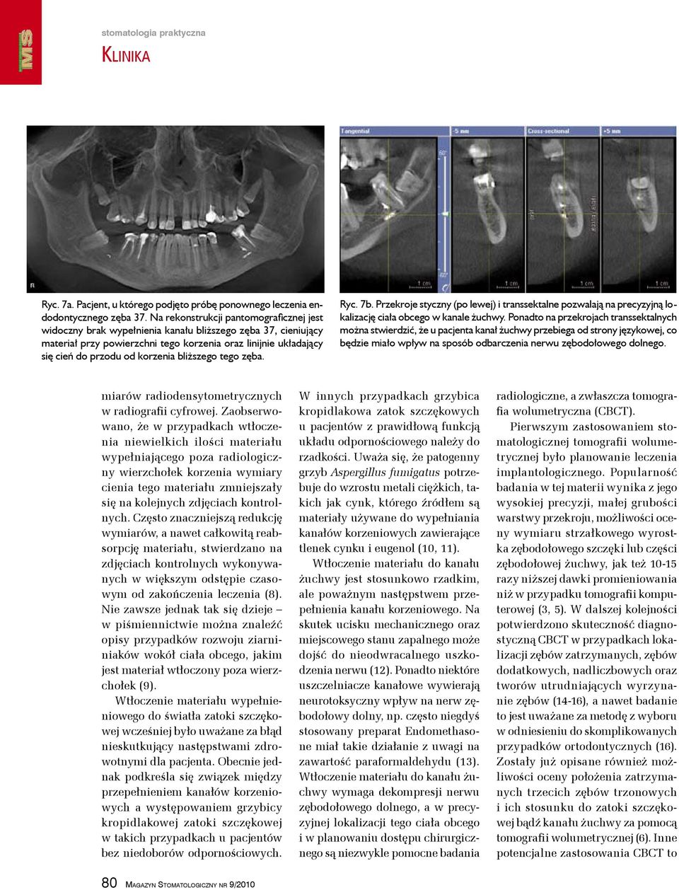 bliższego tego zęba. Ryc. 7b. Przekroje styczny (po lewej) i transsektalne pozwalają na precyzyjną lokalizację ciała obcego w kanale żuchwy.