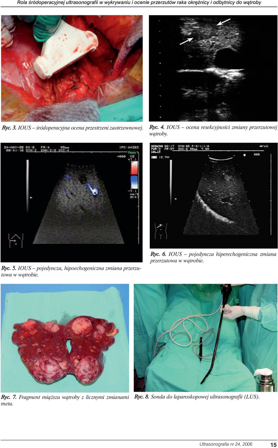 IOUS pojedyncza, hipoechogeniczna zmiana przerzutowa w wàtrobie. Ryc. 6.