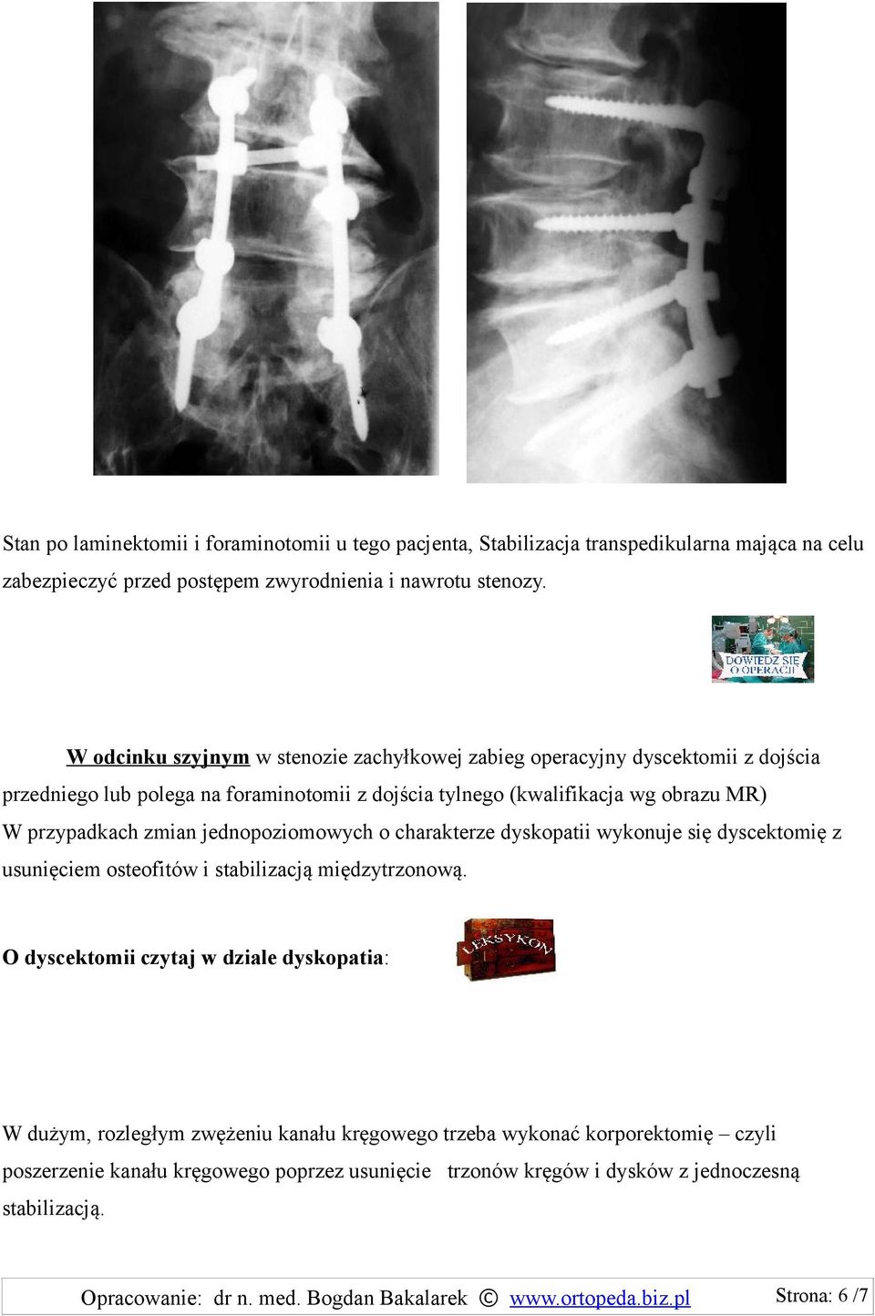 jednopoziomowych o charakterze dyskopatii wykonuje się dyscektomię z usunięciem osteofitów i stabilizacją międzytrzonową.