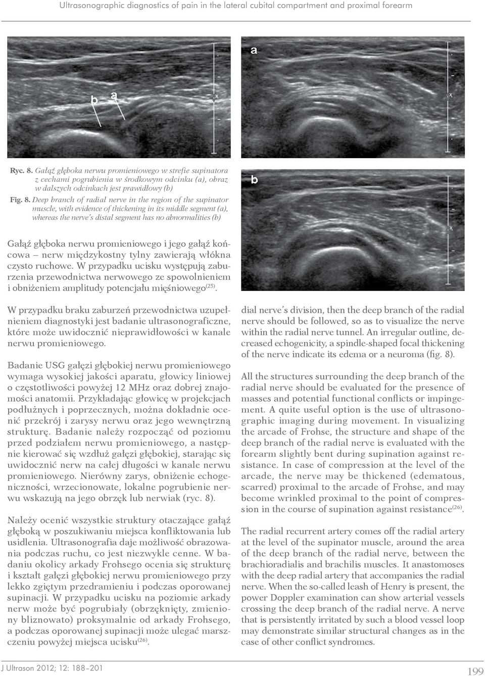 Deep branch of radial nerve in the region of the supinator muscle, with evidence of thickening in its middle segment (a), whereas the nerve s distal segment has no abnormalities (b) Gałąź głęboka