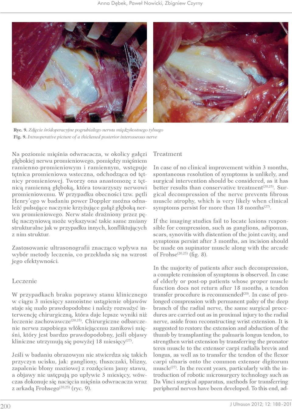 Intraoperative picture of a thickened posterior interosseous nerve Na poziomie mięśnia odwracacza, w okolicy gałęzi głębokiej nerwu promieniowego, pomiędzy mięśniem ramienno -promieniowym i