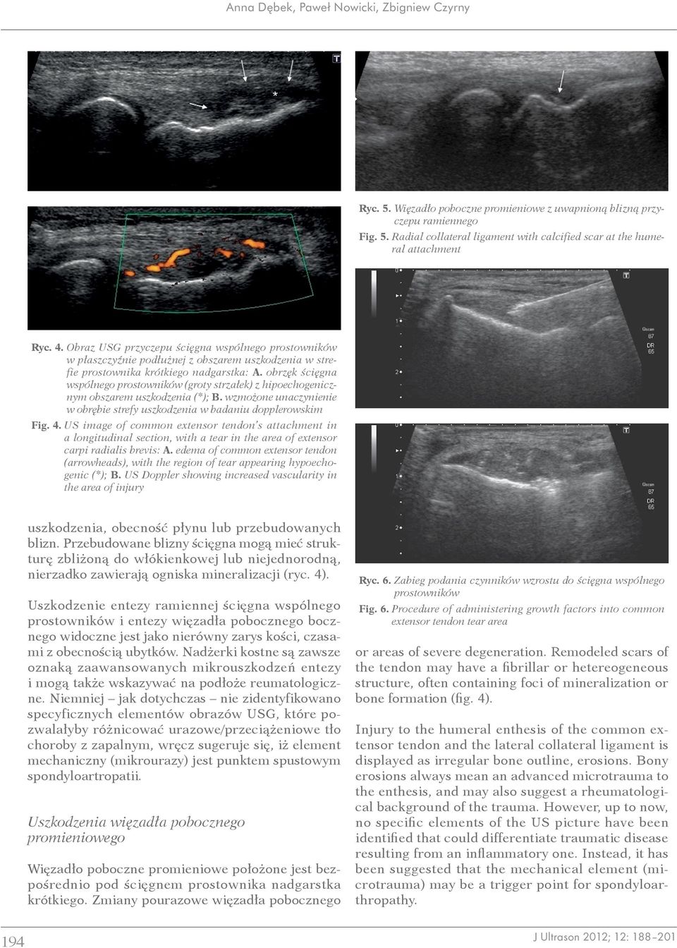 obrzęk ścięgna wspólnego prostowników (groty strzałek) z hipoechogenicznym obszarem uszkodzenia (*); B. wzmożone unaczynienie w obrębie strefy uszkodzenia w badaniu dopplerowskim Fig. 4.