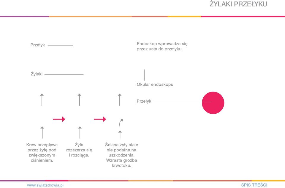 Żylaki Okular endoskopu Przełyk Krew przepływa przez żyłę pod