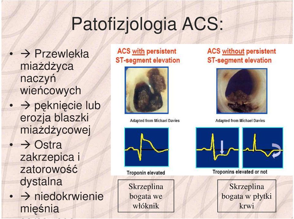 Ostra zakrzepica i zatorowość dystalna niedokrwienie