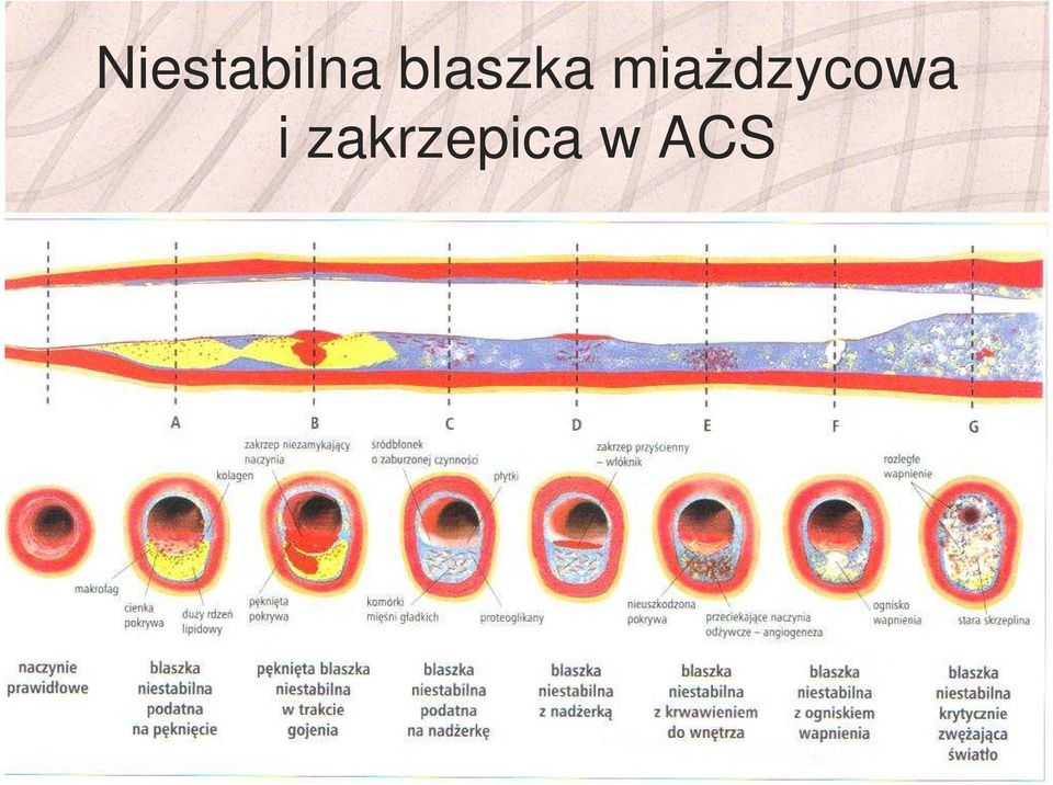 miażdzycowa