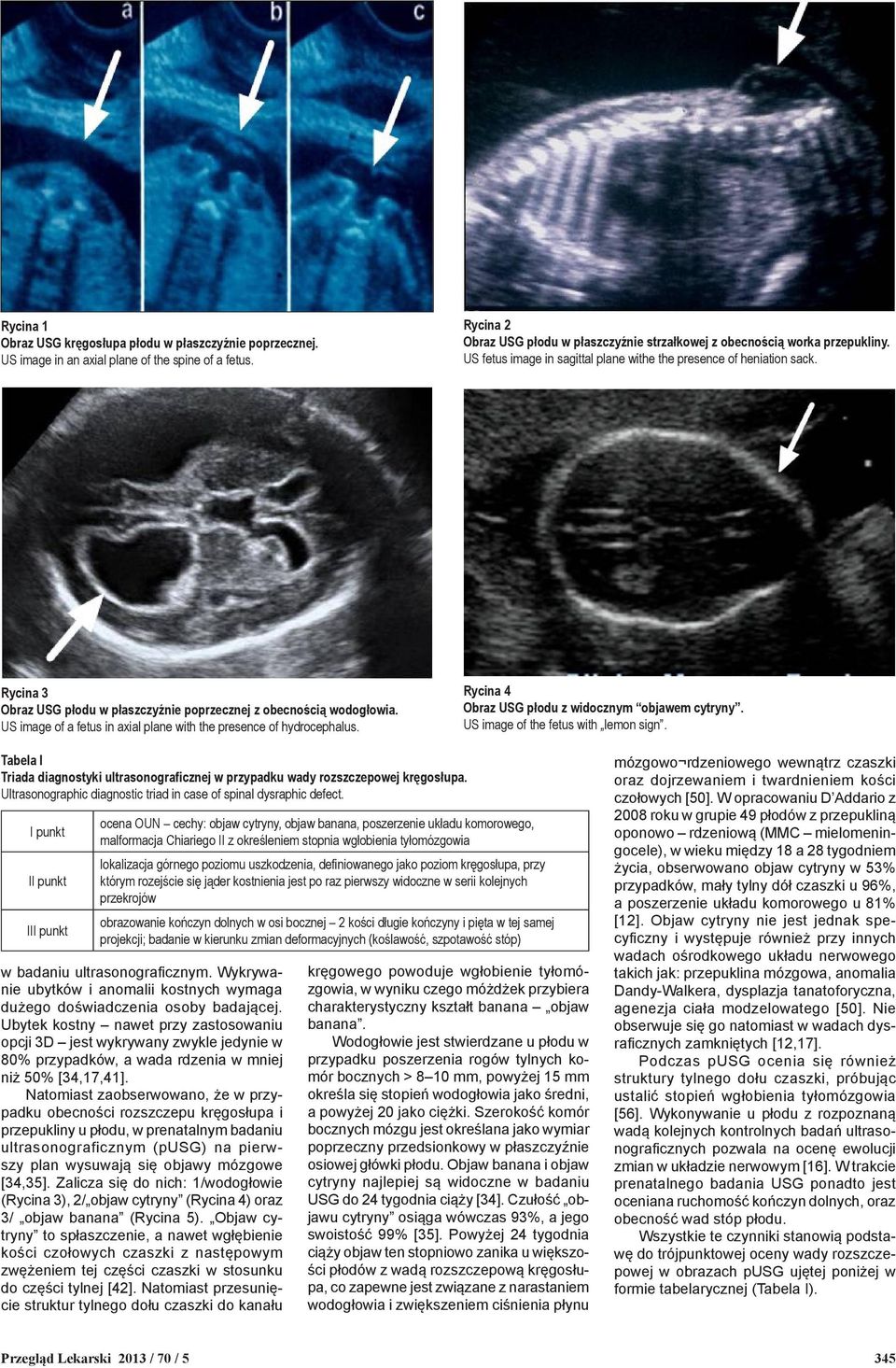 US image of a fetus in axial plane with the presence of hydrocephalus. Rycina 4 Obraz USG płodu z widocznym objawem cytryny. US image of the fetus with lemon sign.